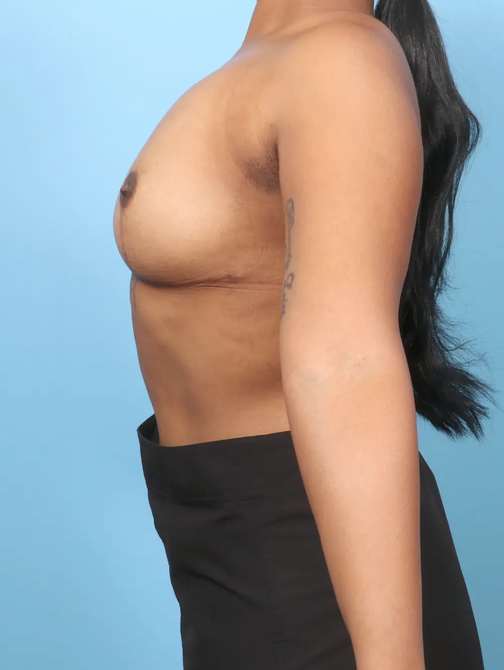 Breast Implant Removal Patient Photo - Case 60234 - after view-2