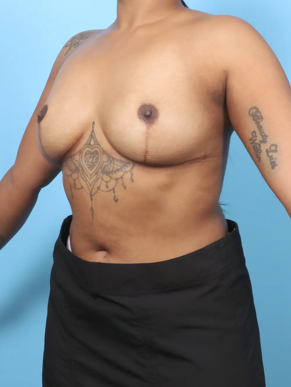 Breast Implant Removal Patient Photo - Case 60234 - after view-1