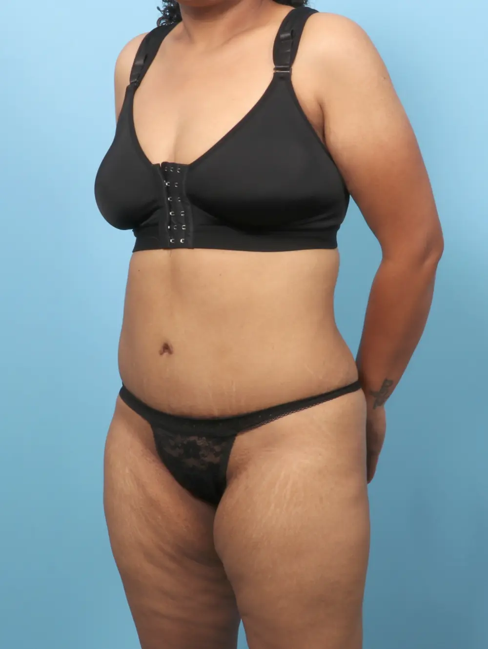 Tummy Tuck Patient Photo - Case 60301 - after view-1
