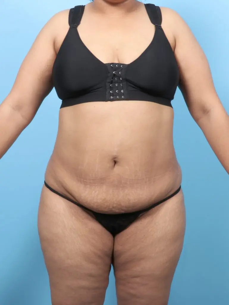 Tummy Tuck - Case 60301 - Before