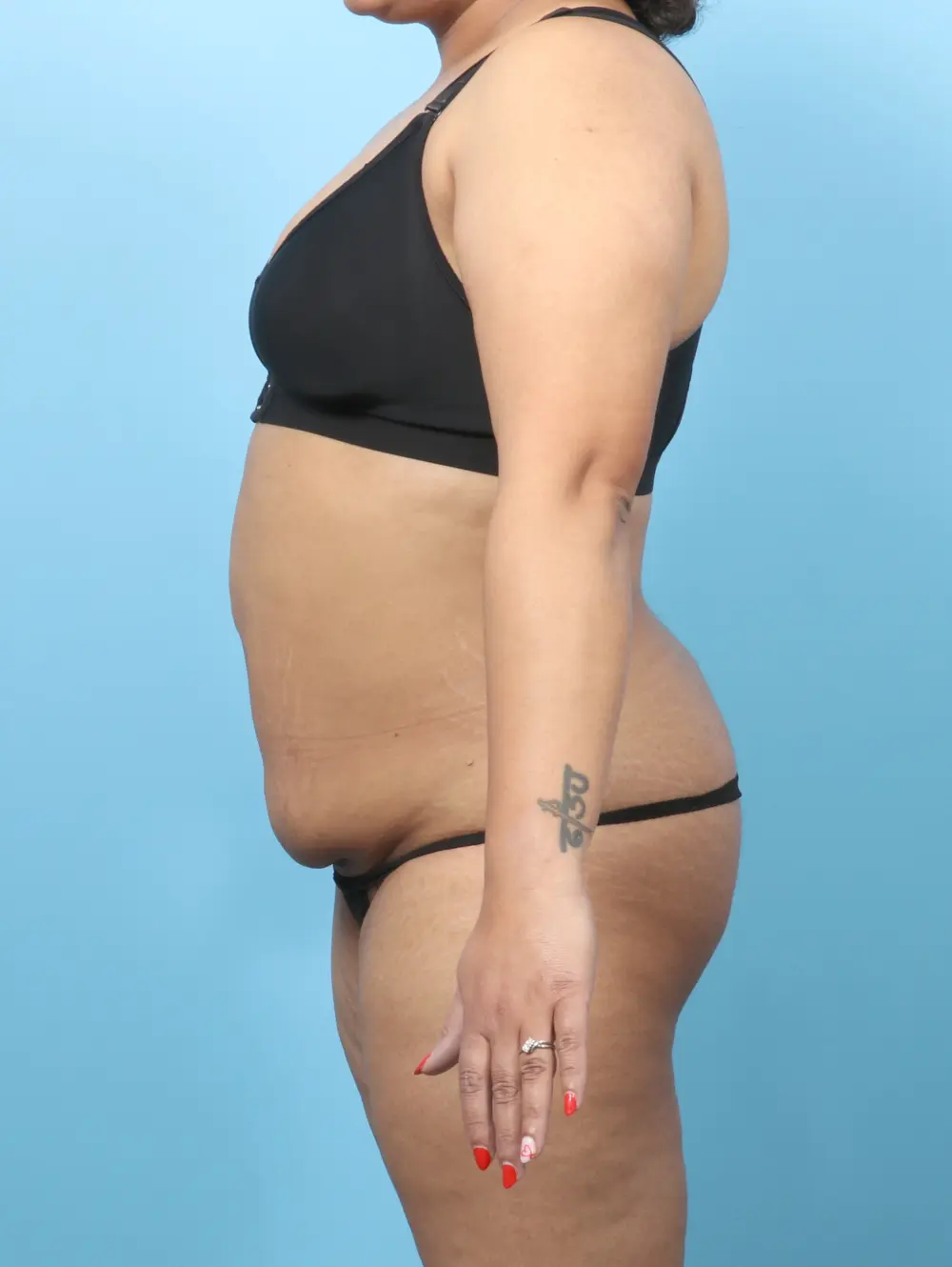 Tummy Tuck Patient Photo - Case 60301 - before view-2
