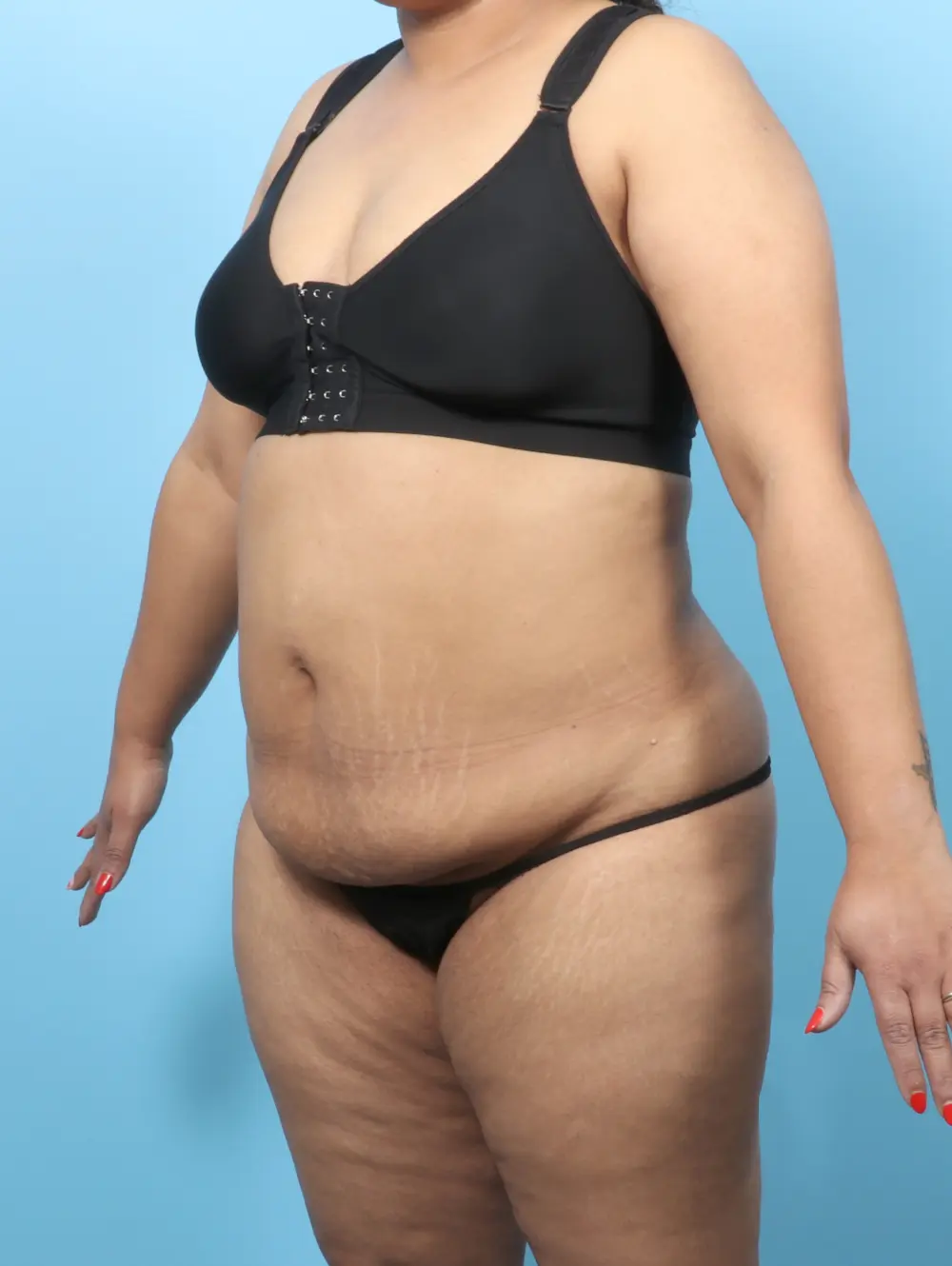 Tummy Tuck Patient Photo - Case 60301 - before view-1
