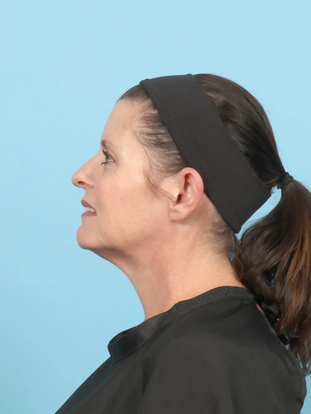 Otoplasty Patient Photo - Case 60317 - before view-2