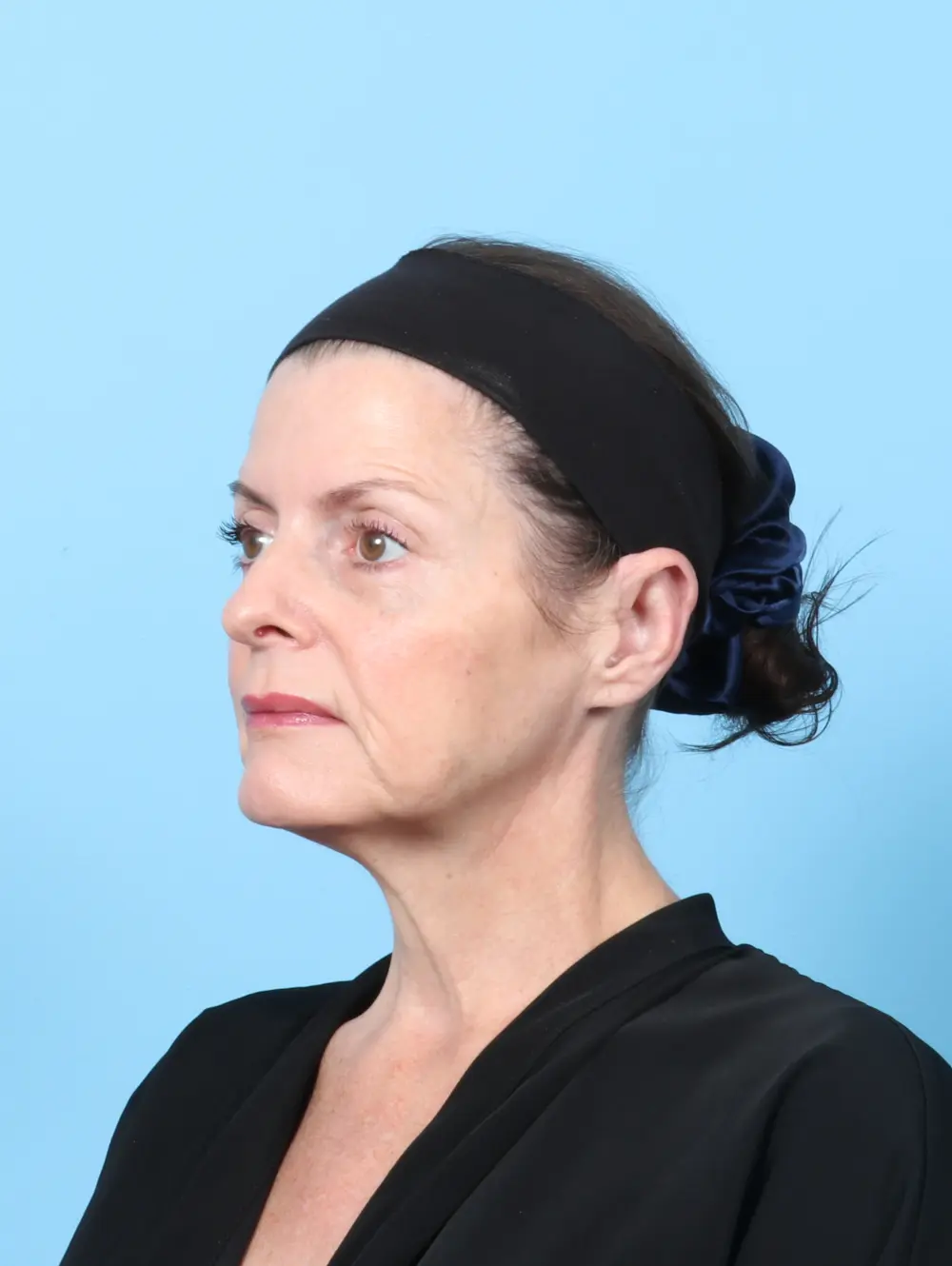 Otoplasty Patient Photo - Case 60317 - after view-1