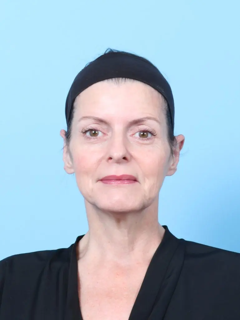 Otoplasty - Case 60317 - After