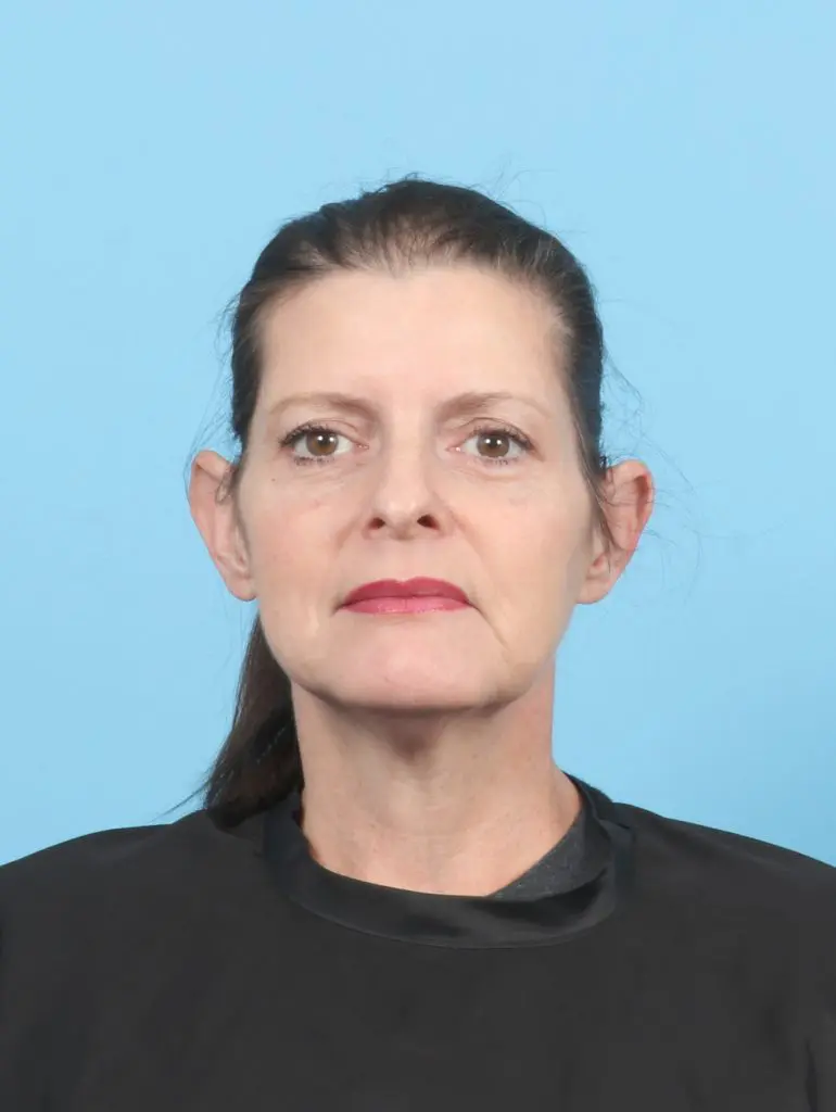 Otoplasty - Case 60317 - Before