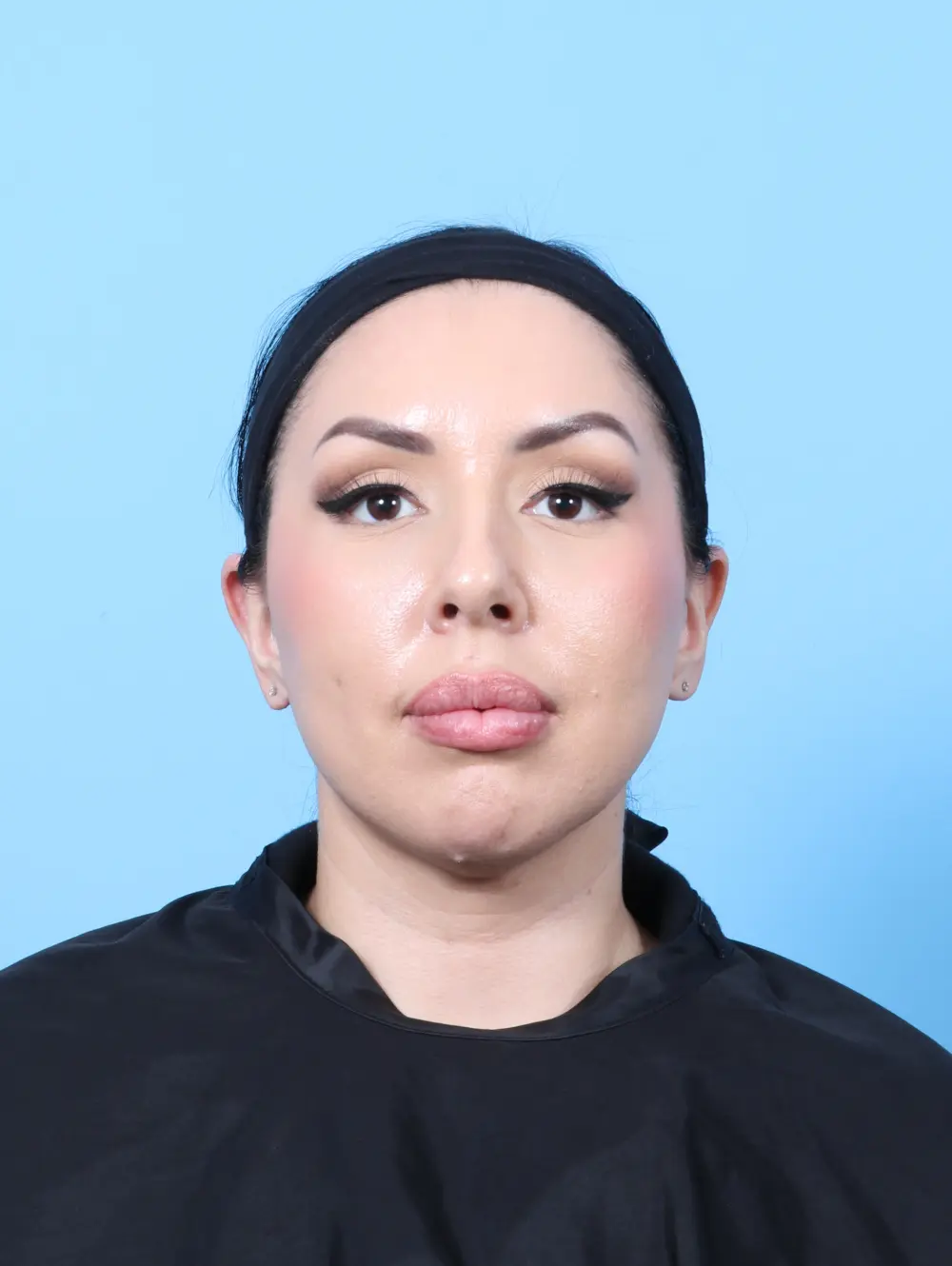 Rhinoplasty Patient Photo - Case 60333 - before view-2