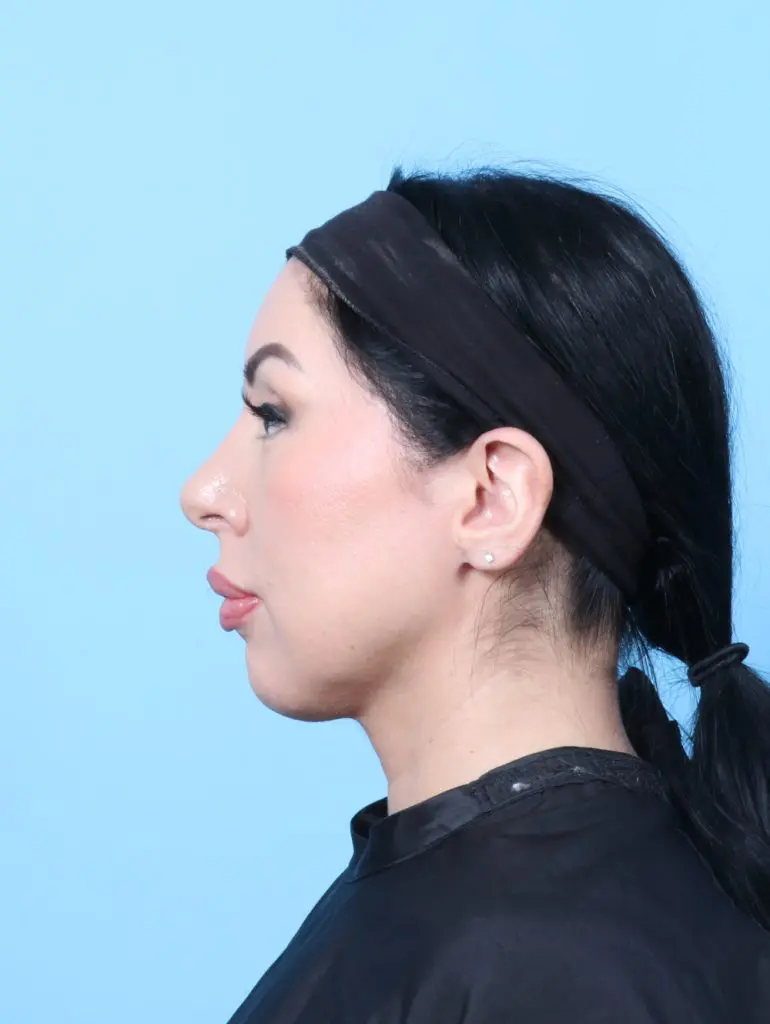 Rhinoplasty - Case 60333 - After