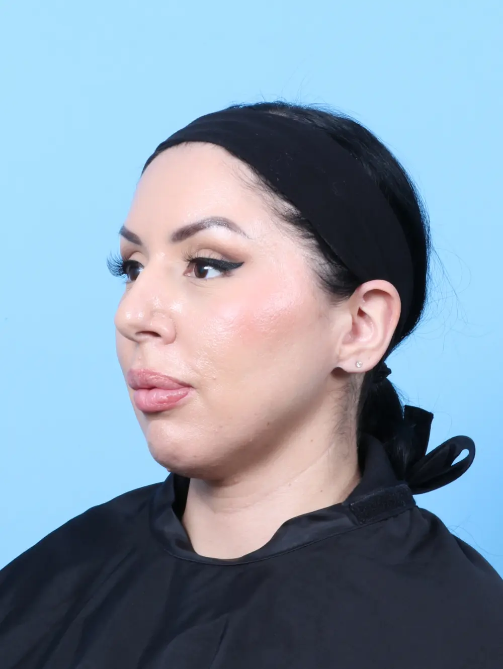 Rhinoplasty Patient Photo - Case 60333 - before view-1