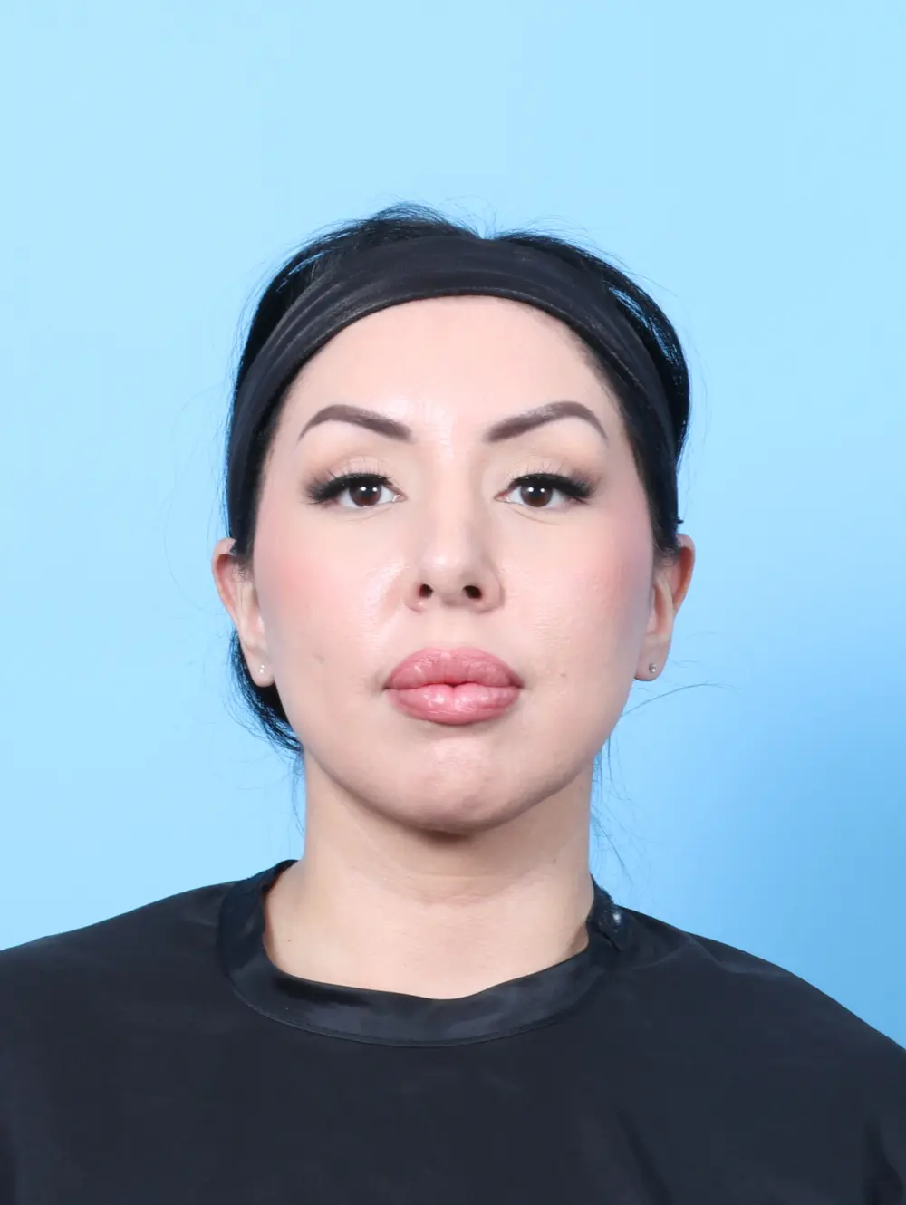 Rhinoplasty Patient Photo - Case 60333 - after view-2