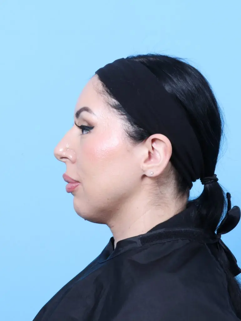 Rhinoplasty - Case 60333 - Before