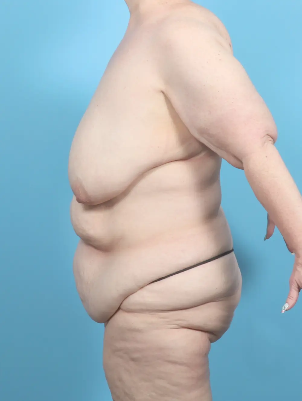 After Weight Loss Patient Photo - Case 60357 - before view-2