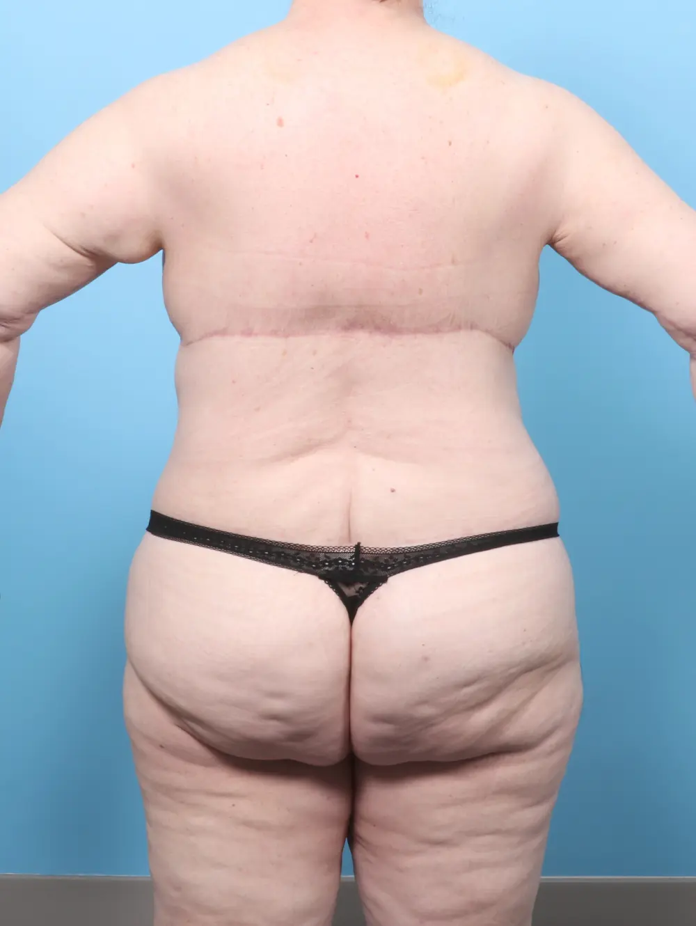 After Weight Loss Patient Photo - Case 60357 - after view-3