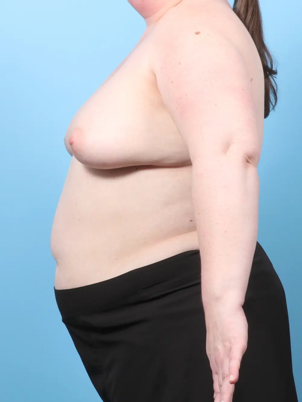 Breast Implant Removal Patient Photo - Case 60367 - before view-2