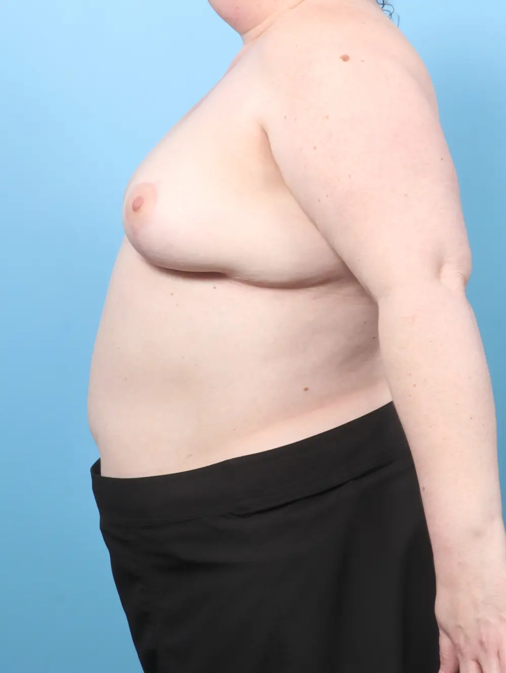 Breast Implant Removal Patient Photo - Case 60367 - after view-2