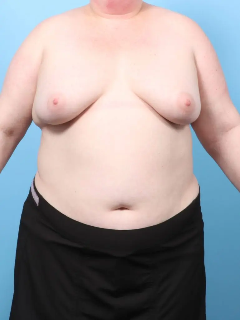 Breast Implant Removal - Case 60367 - Before