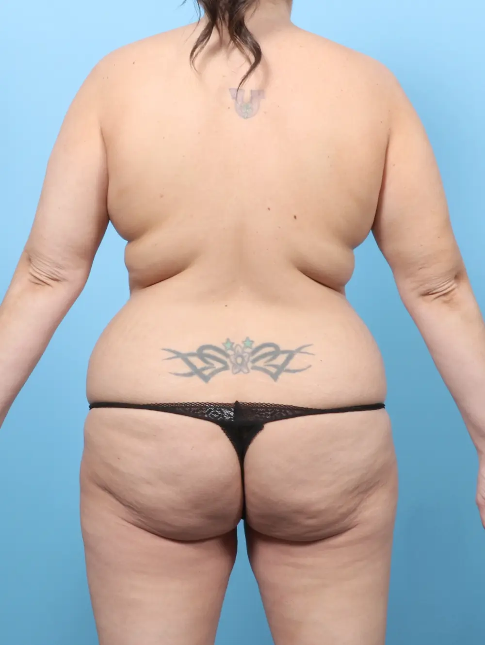 Breast Lift/Reduction with Implants Patient Photo - Case 60386 - before view-3