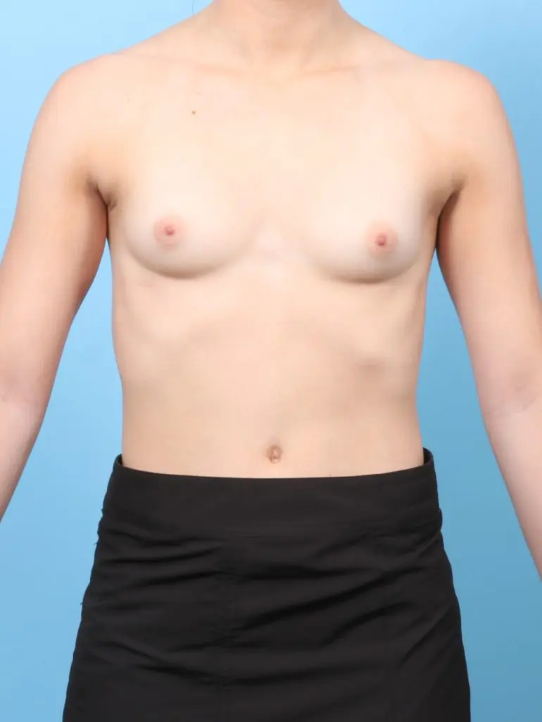 Breast Augmentation - Case 60412 - Before