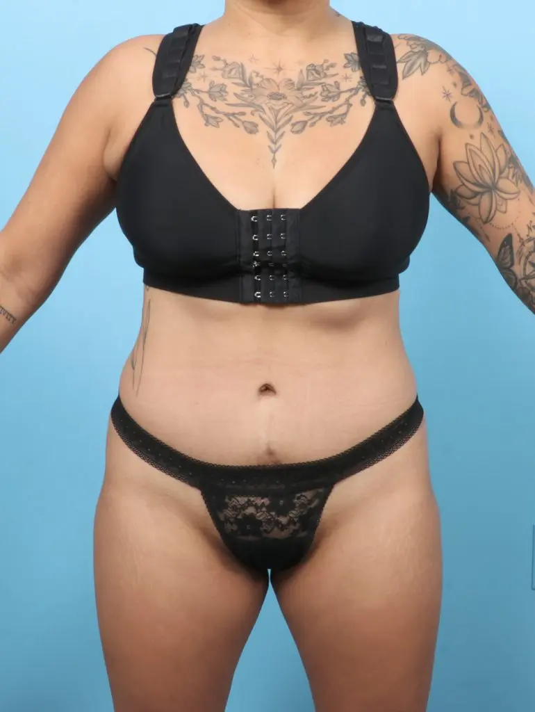 Tummy Tuck - Case 60420 - After