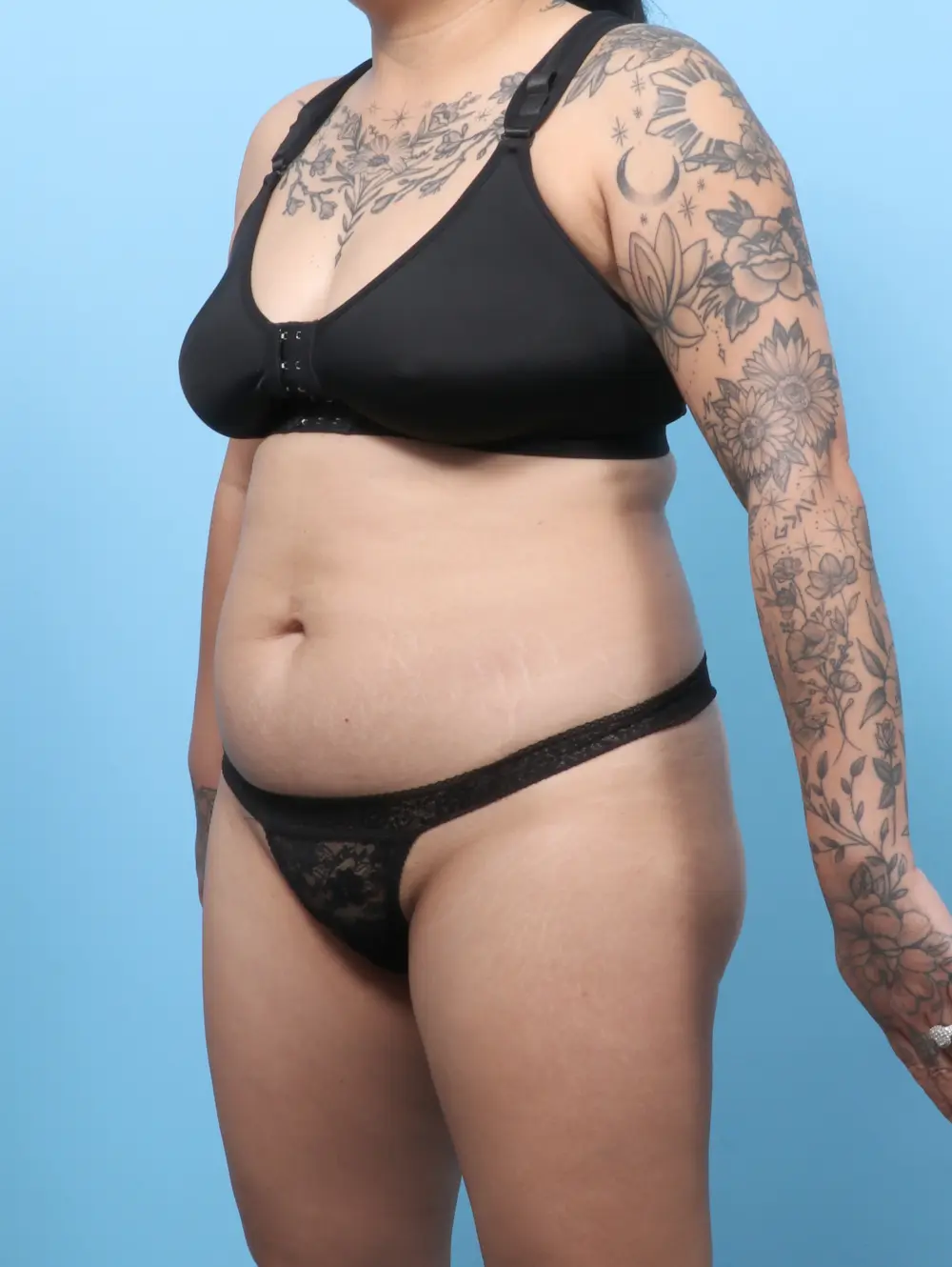 Tummy Tuck Patient Photo - Case 60420 - before view-1