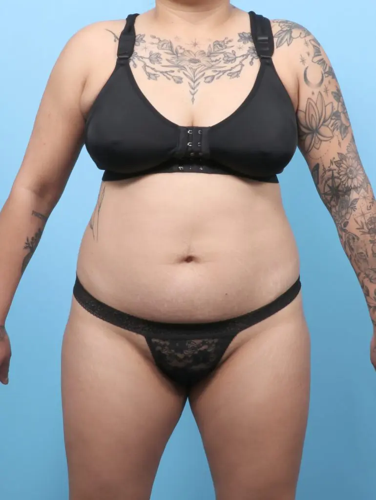 Tummy Tuck - Case 60420 - Before