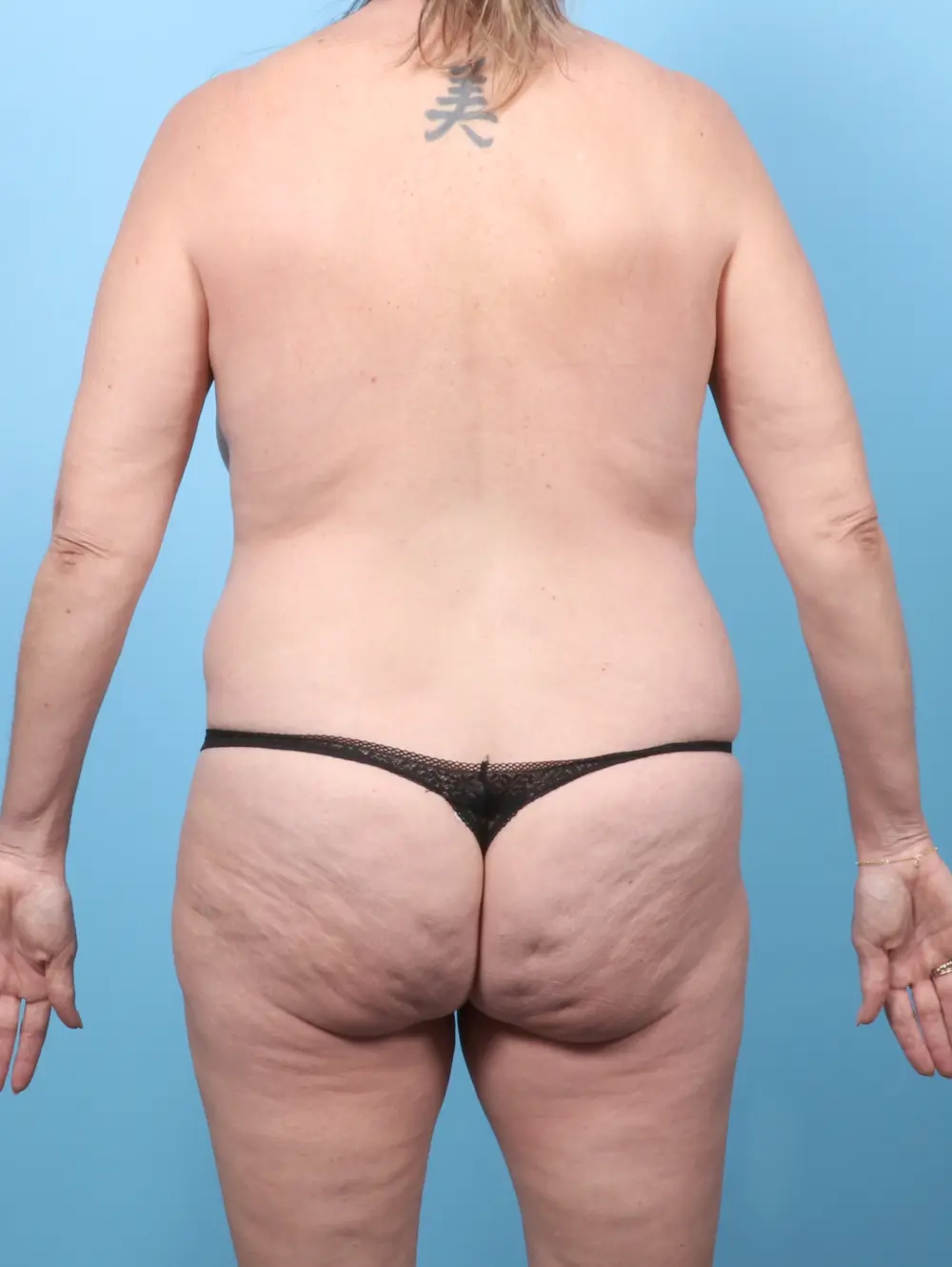 Breast Lift/Reduction w/o Implants Patient Photo - Case 60428 - before view-3