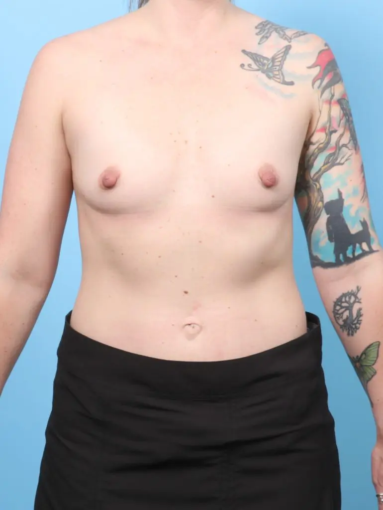 Breast Augmentation - Case 60481 - Before