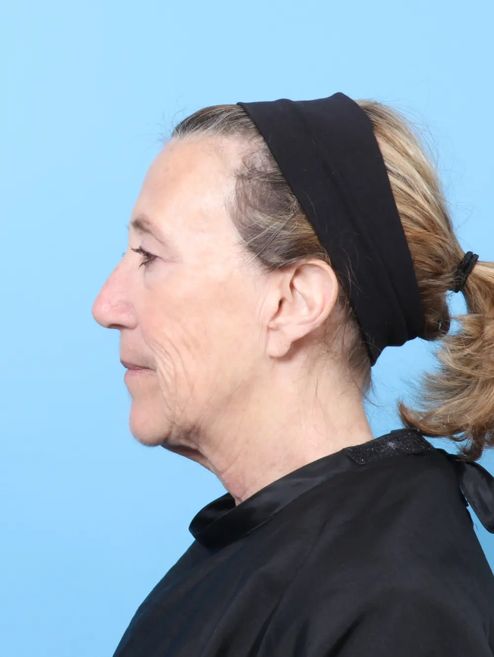 Laser Resurfacing Patient Photo - Case 60490 - before view-2
