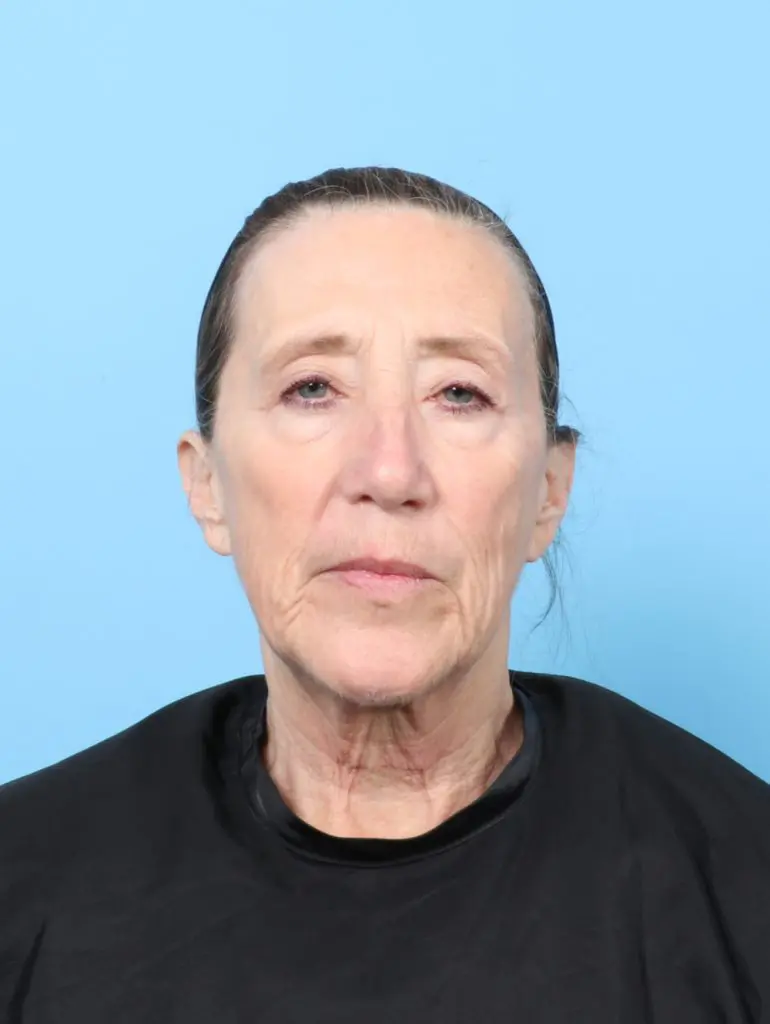 Laser Resurfacing - Case 60490 - Before