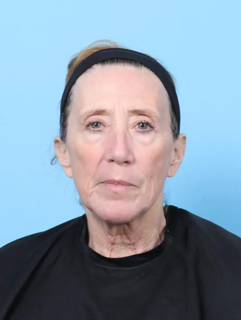 Laser Resurfacing - Case 60490 - After