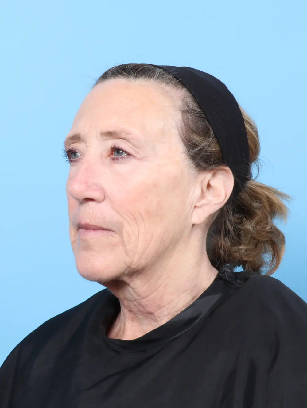 Laser Resurfacing Patient Photo - Case 60490 - before view-1