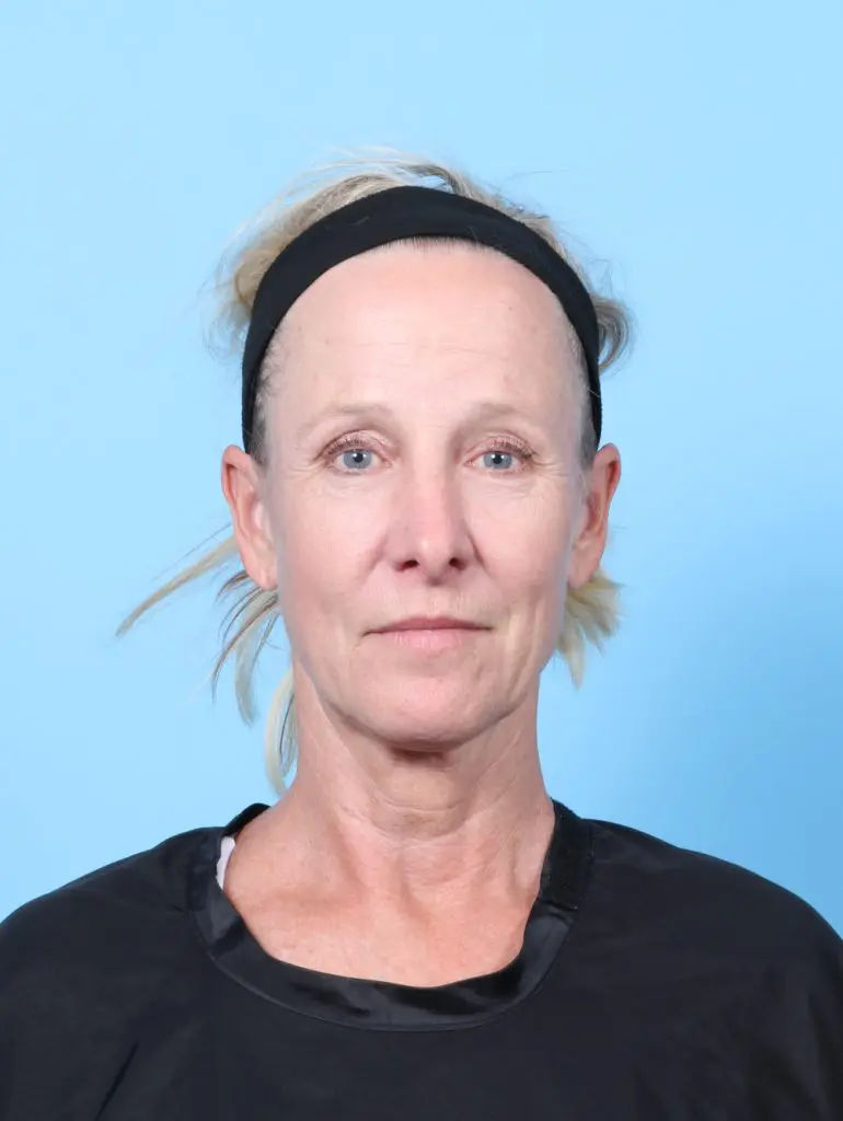 Brow Lift - Case 60498 - Before