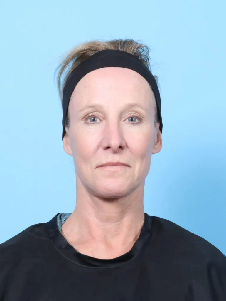 Brow Lift - Case 60498 - After