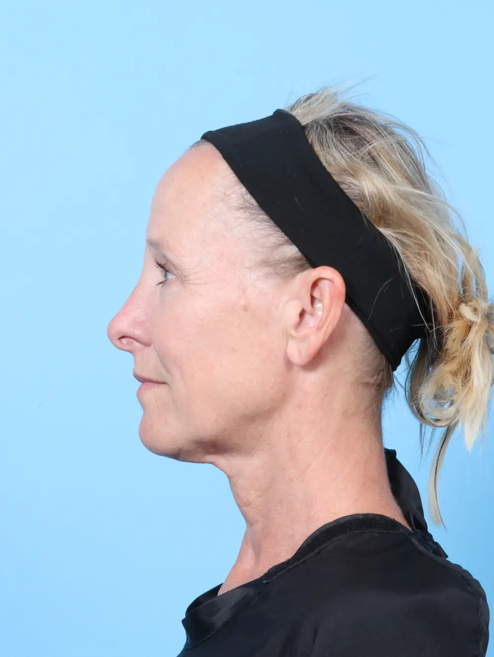 Brow Lift Patient Photo - Case 60498 - before view-2