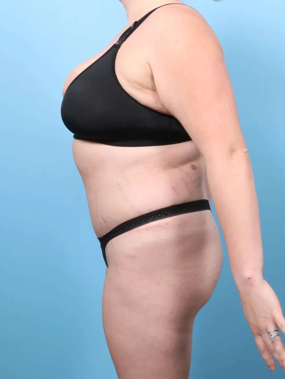 Tummy Tuck Patient Photo - Case 60545 - after view-2