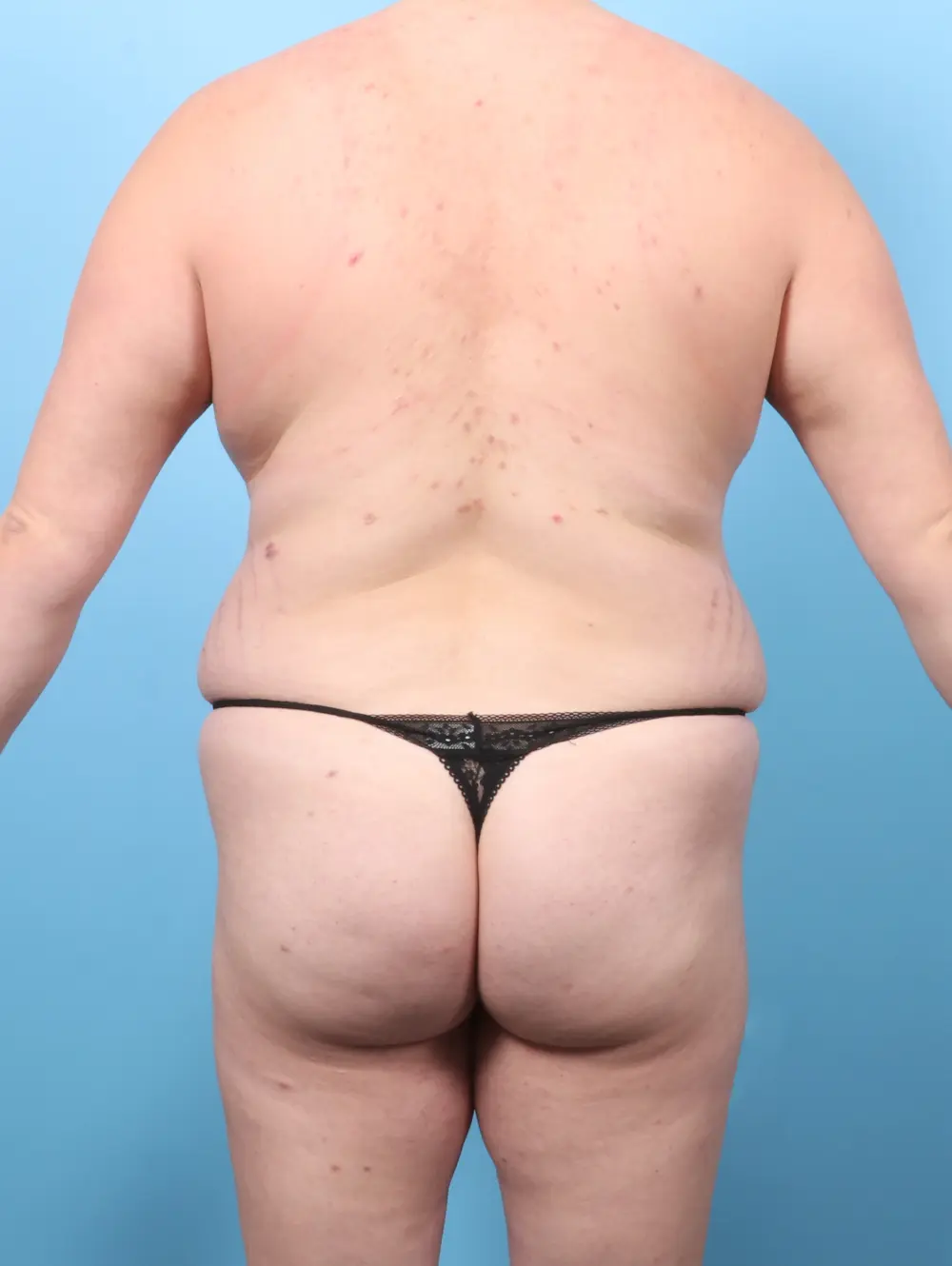 Tummy Tuck Patient Photo - Case 60545 - after view-3