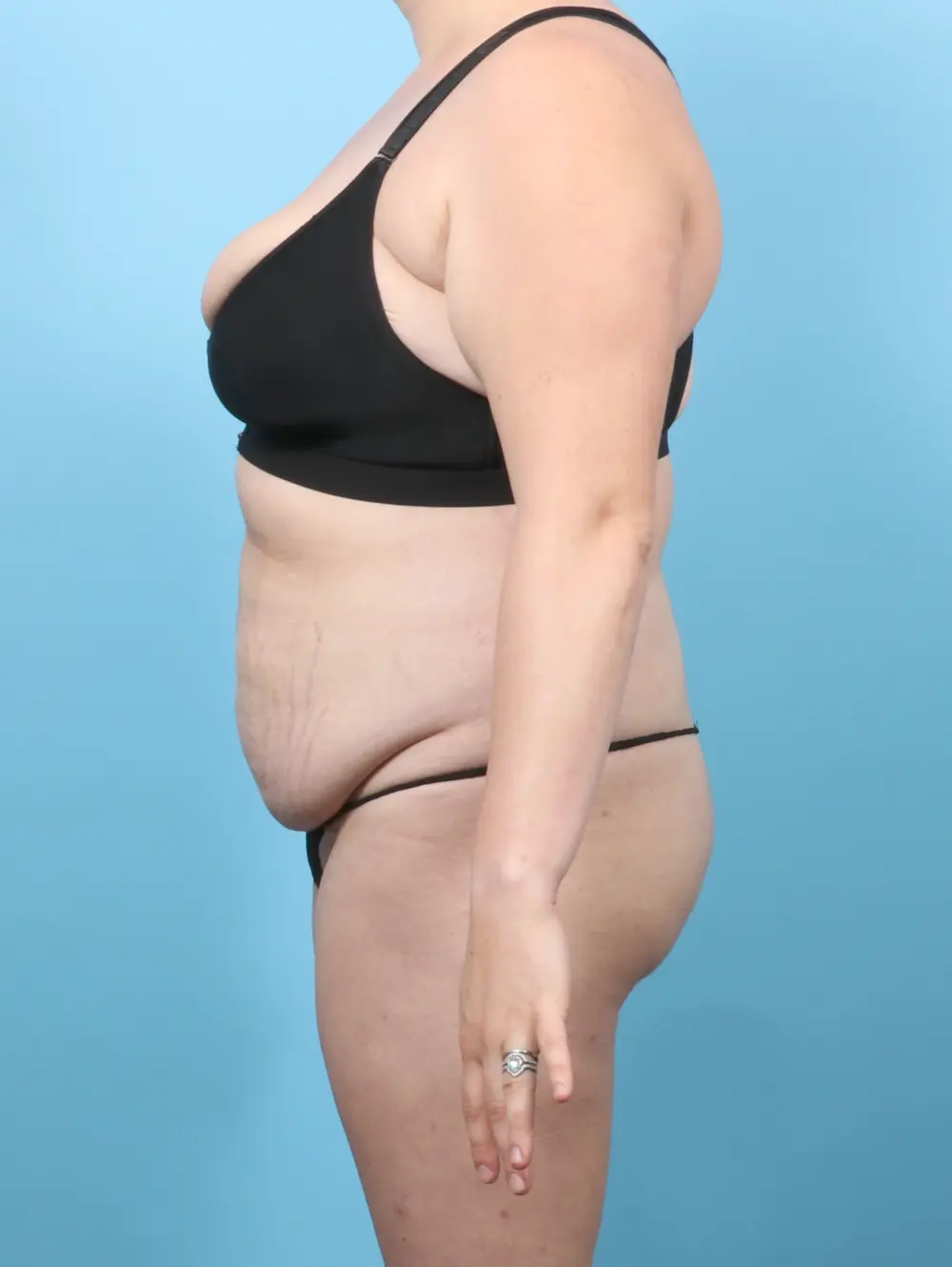 Tummy Tuck Patient Photo - Case 60545 - before view-2
