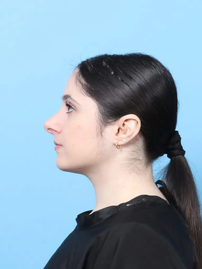 Rhinoplasty - Case 60555 - After
