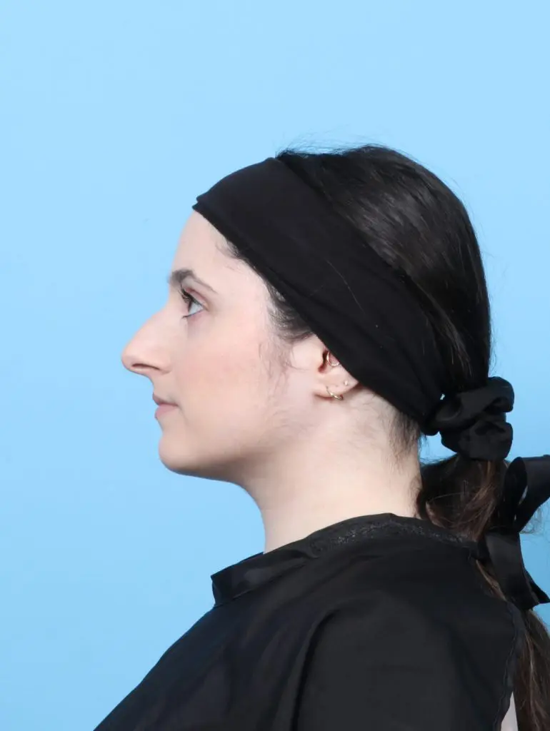 Rhinoplasty - Case 60555 - Before