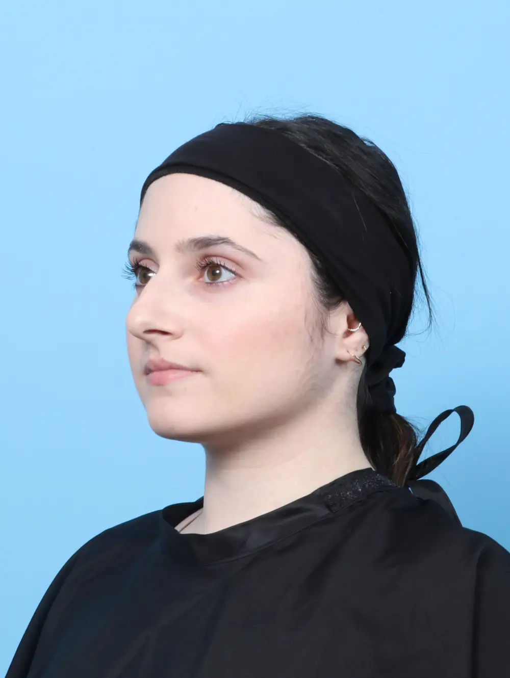 Rhinoplasty Patient Photo - Case 60555 - before view-1