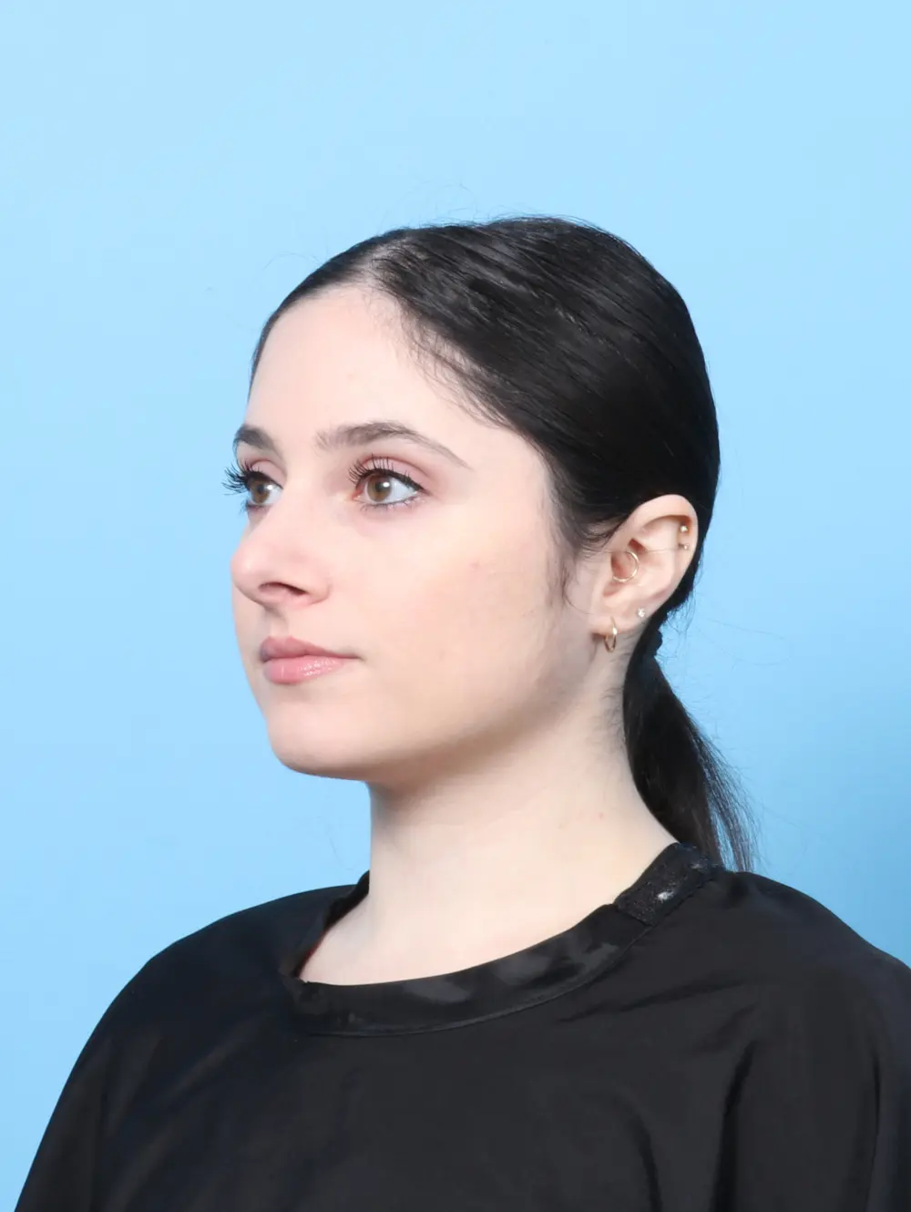 Rhinoplasty Patient Photo - Case 60555 - after view-1