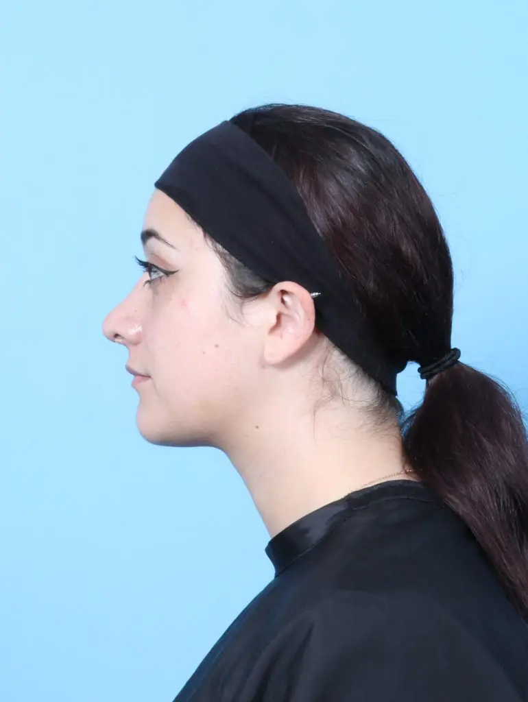 Rhinoplasty - Case 60571 - After