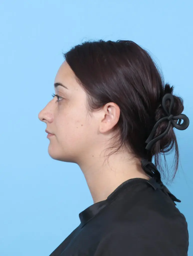 Rhinoplasty - Case 60571 - Before