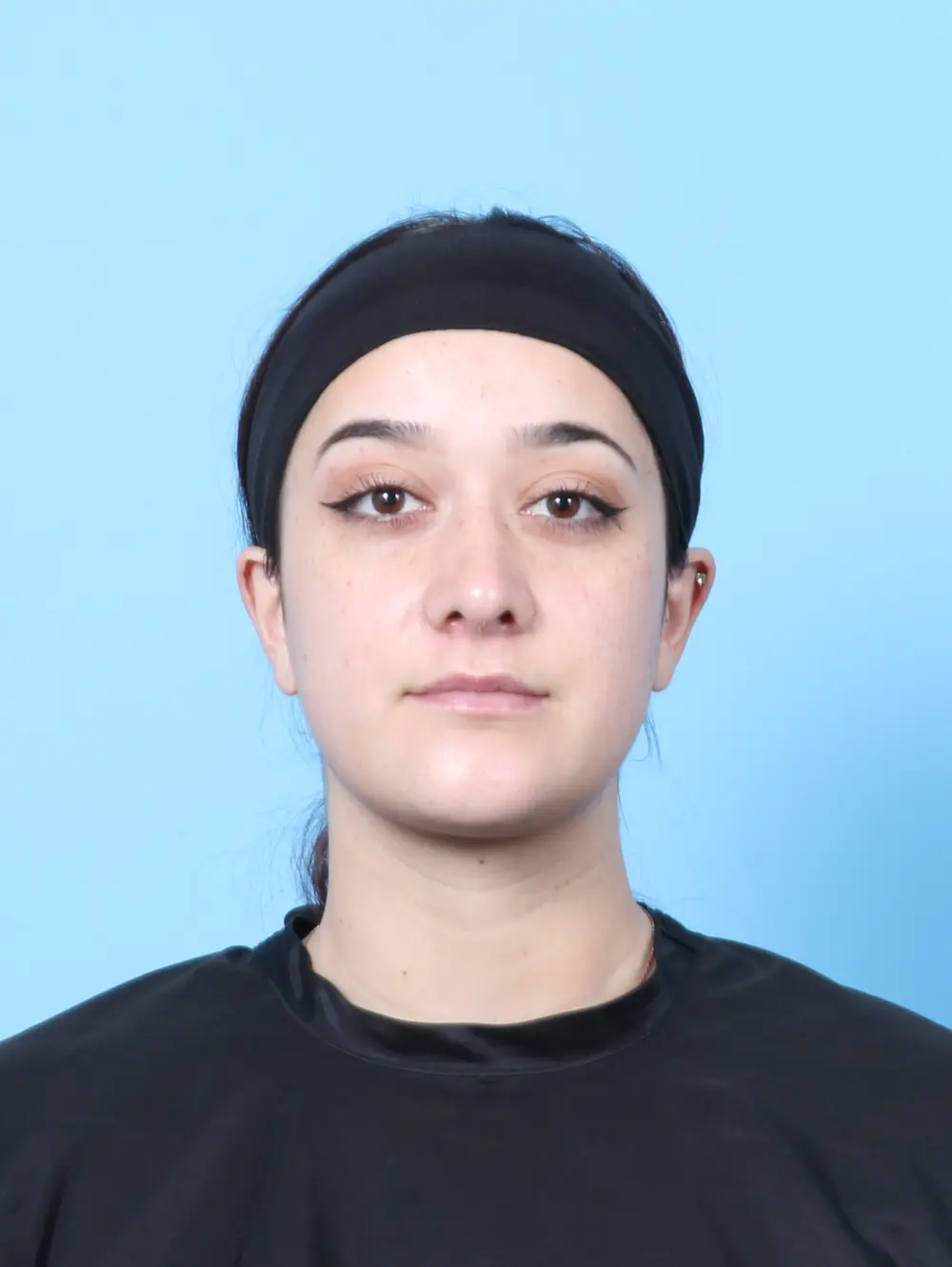 Rhinoplasty Patient Photo - Case 60571 - after view-2
