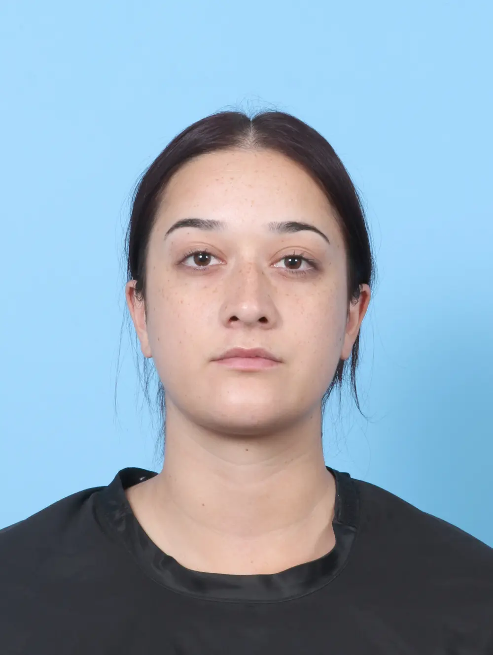 Rhinoplasty Patient Photo - Case 60571 - before view-2