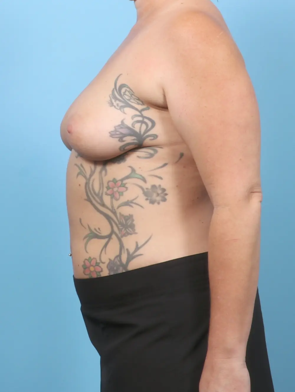 Breast Lift/Reduction with Implants Patient Photo - Case 60579 - before view-2
