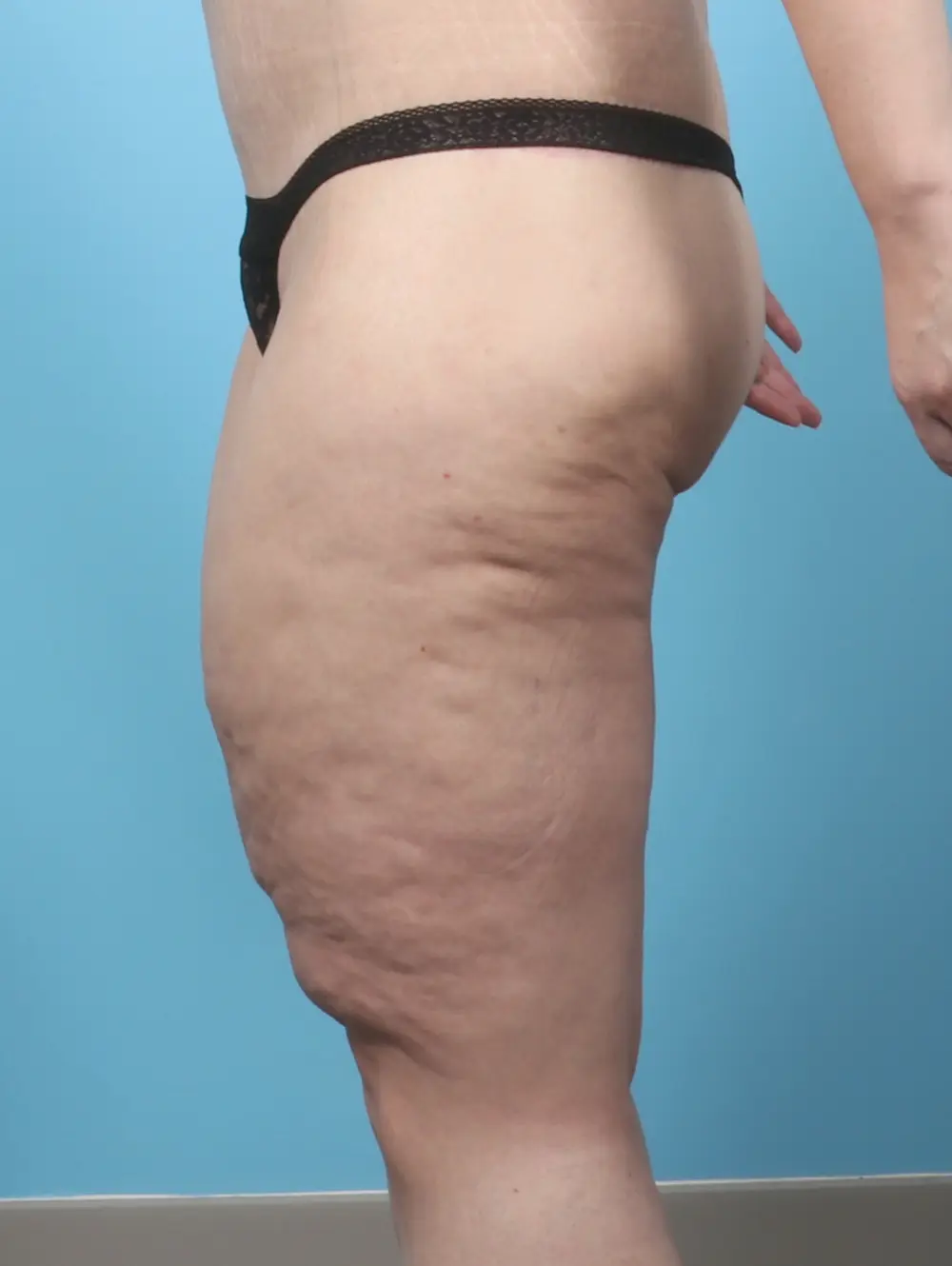 After Weight Loss Patient Photo - Case 60611 - before view-2