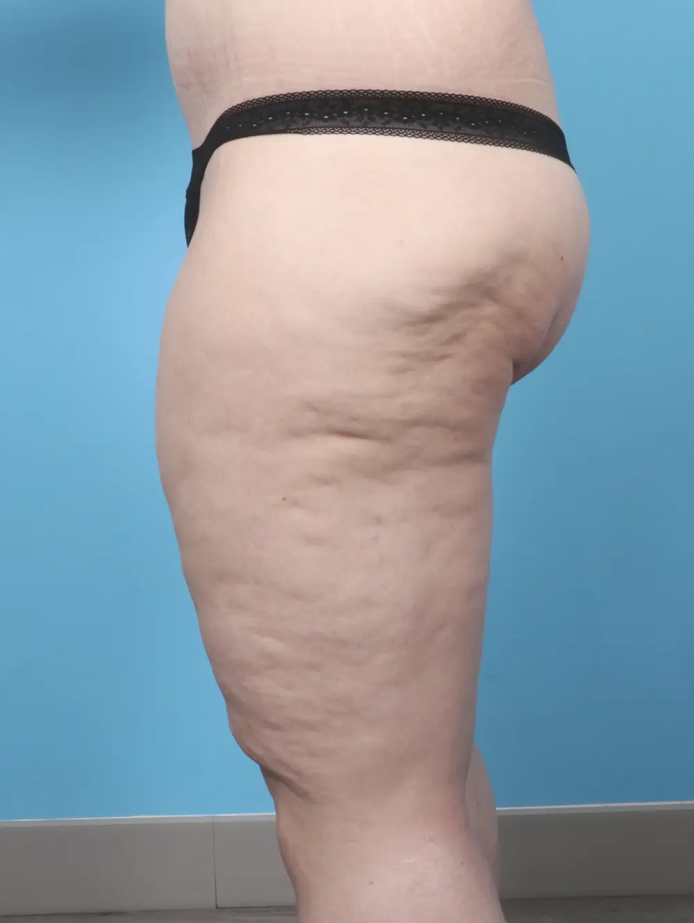 After Weight Loss Patient Photo - Case 60611 - after view-2
