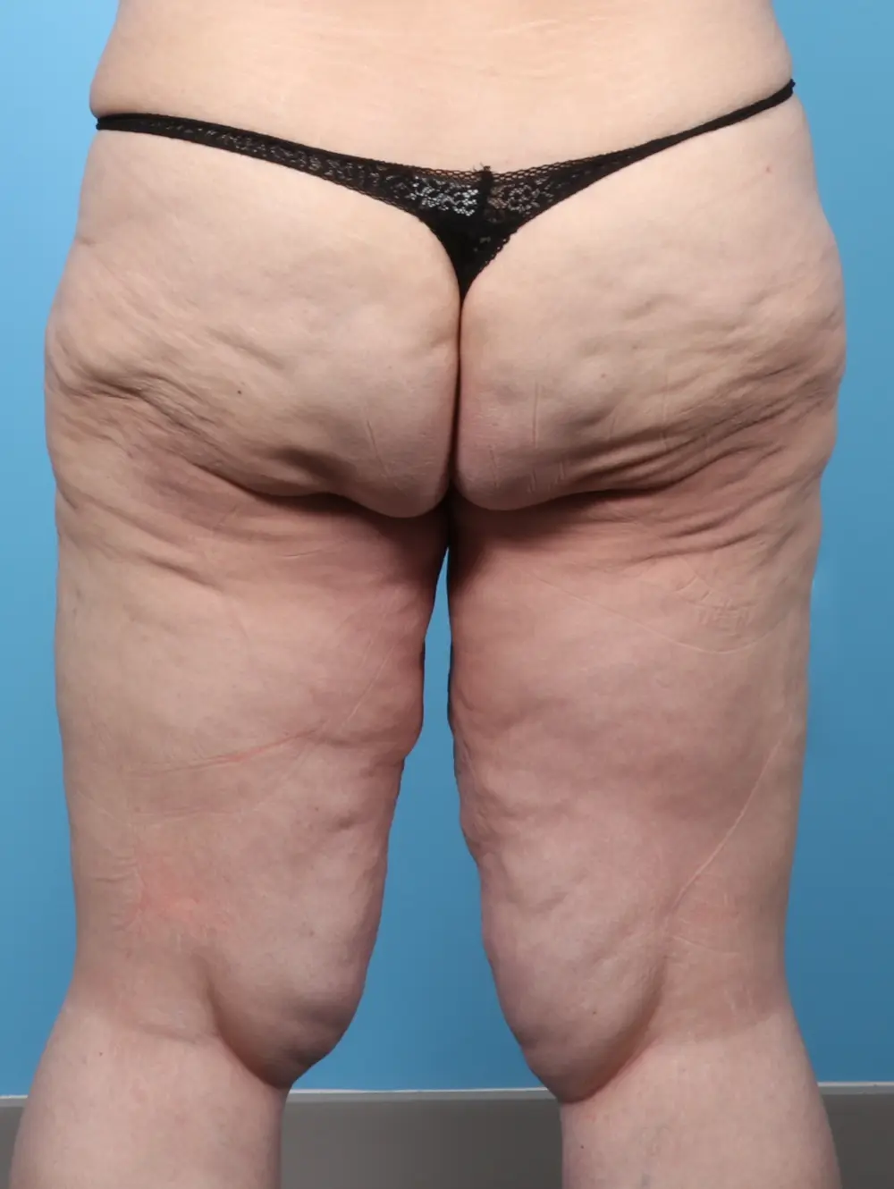 After Weight Loss Patient Photo - Case 60611 - before view-3