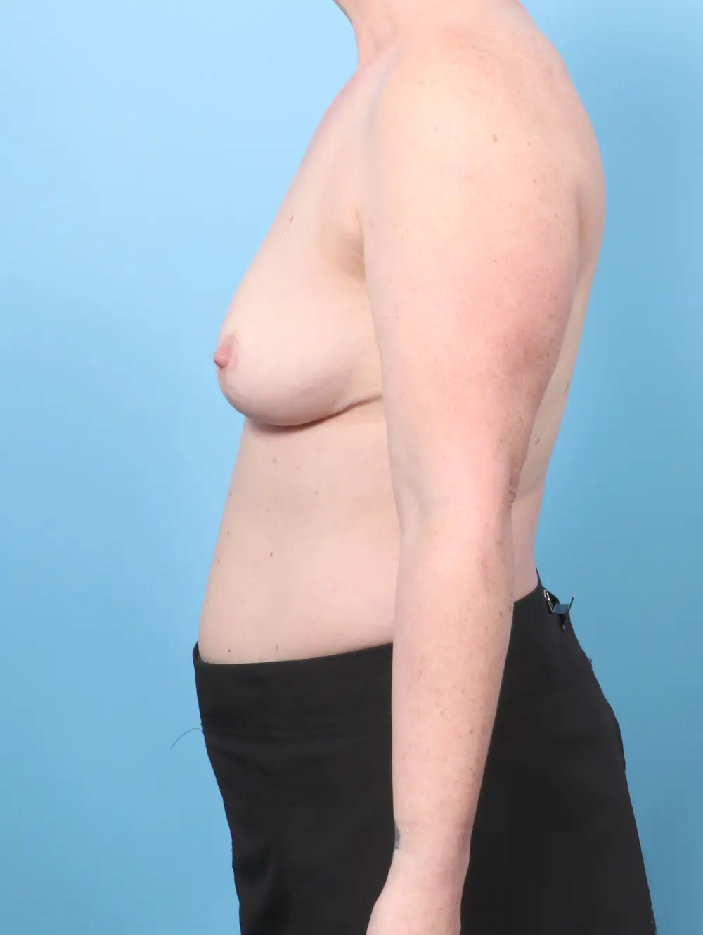 Breast Lift/Reduction w/o Implants Patient Photo - Case 60637 - after view-2